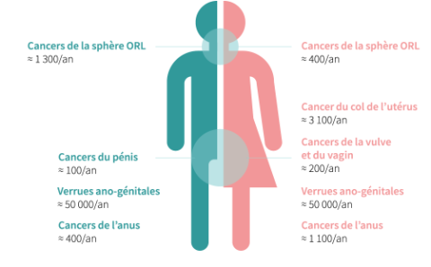 Cancers induits par le papillomavirus